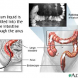 Colonics and Constipation